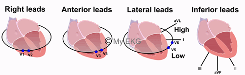 Anterior, Inferior, Lateral and Right Leads