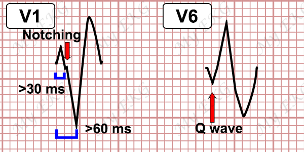 Ventricular Tachycardia Criteria with LBBB-pattern