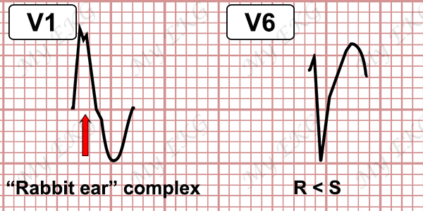 Ventricular Tachycardia Criteria with RBBB-pattern