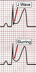 J Wave and Slurring, Electrocardiogram of Early Repolarization Pattern