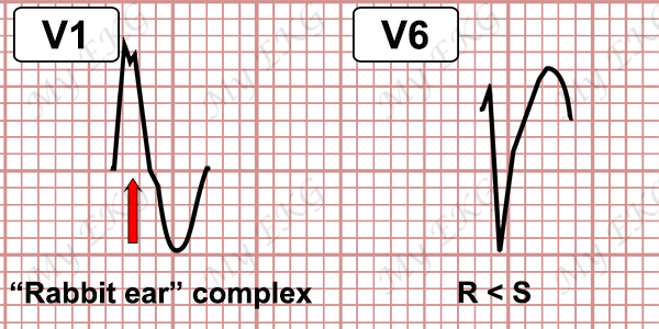 EKG Criteria For Ventricular Tachycardia, 53% OFF