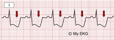 The ST segment: physiology, normal appearance, ST depression & ST elevation  –